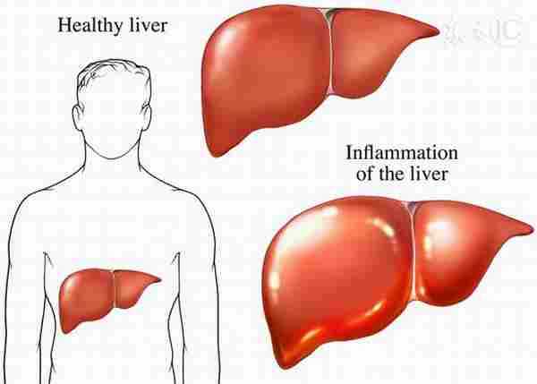 男人最怕伤肝 护肝有两大法宝|肝脏