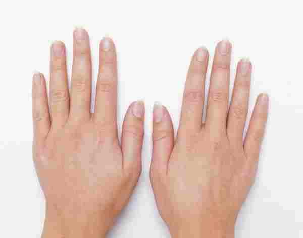 指甲表面有竖线三大原因|营养不良|灰指甲