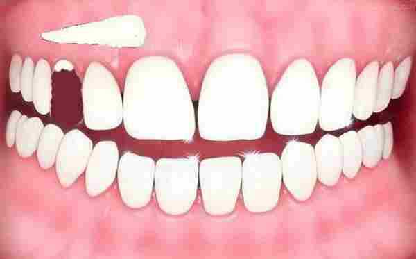 吃什么让牙齿变白|美白|牙齿
